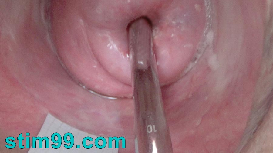 Fucking her prolapsed cervix with huge german metal sound 10 mm
