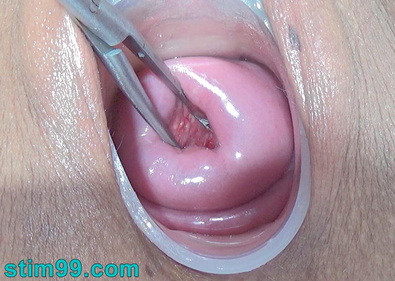 Milf uses a stainless steel Magill forceps as a speculum for stretching her cervix