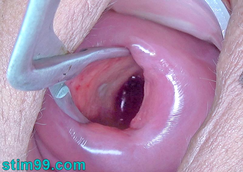 Amazing cervix dilation opening with a Magill medical forceps