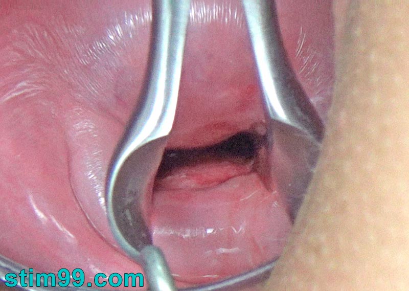 Cervix open wide with long speculum