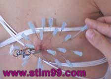 Breast Saline and Needles Play