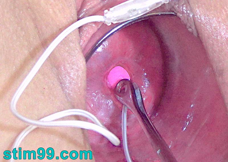 Vibrator into cervix keeping it inside with a clamp