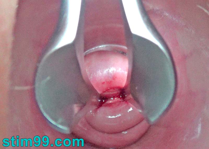 Gapping cervix with speculum