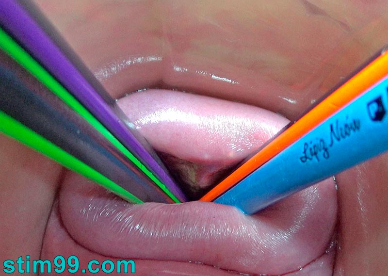 Extreme urethral prolapse