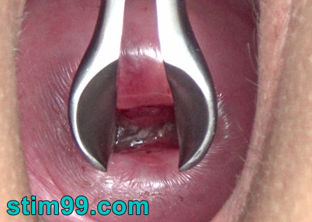 Wide open cervix with speculum