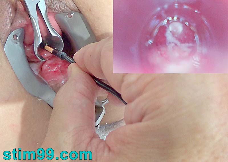 Endoscope camera in woman peehole with bladder full semen