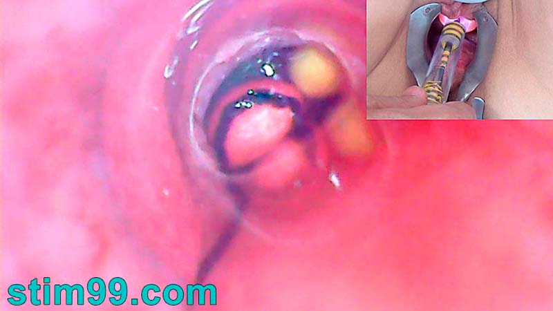 Endoscope Camera in woman peehole with Bladder full Balls