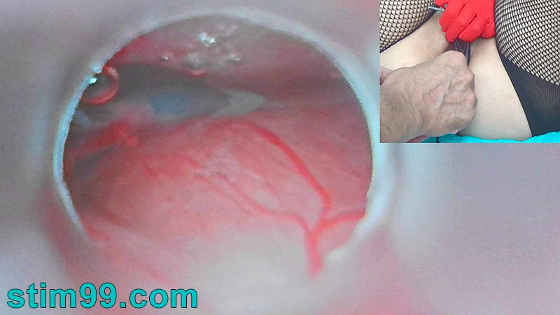 Insemination with semen in cervix while endoscope inside uterus