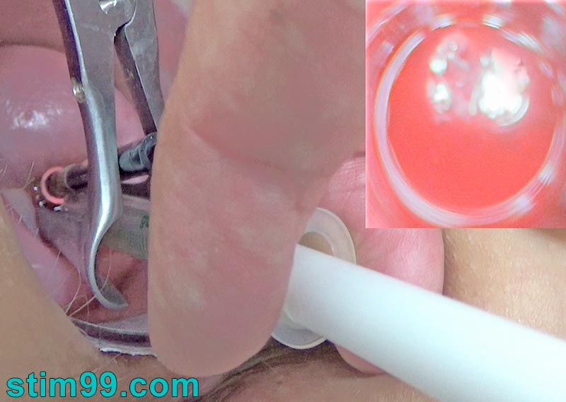 Injecting semen inside uterus with syringe
