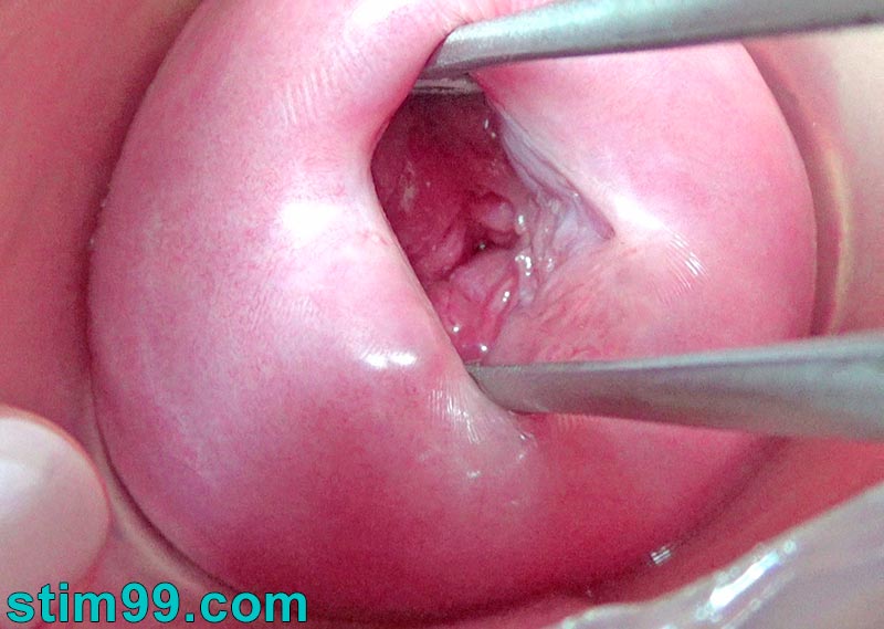 Cervix hole open wide