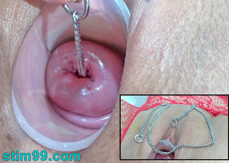 Cervix insertion with a metal chain 60 cm long to fill the uterus