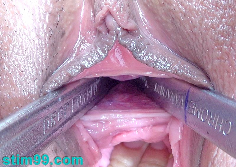 Huge tools like wrenches inserted deeply into the urethra