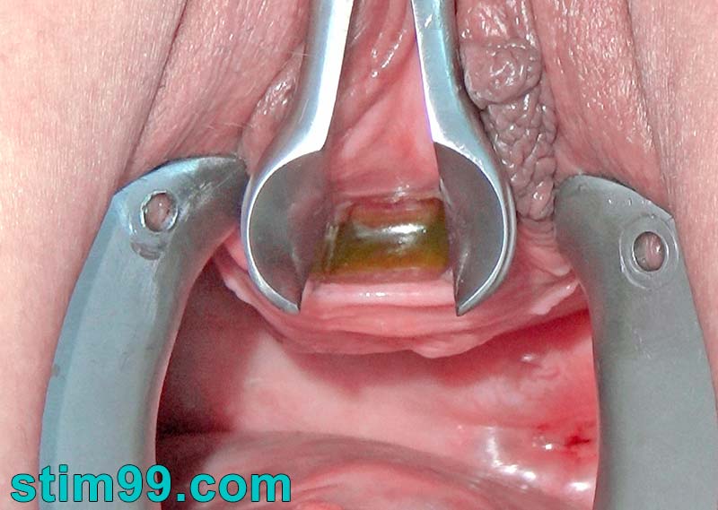Gaping peehole with speculum