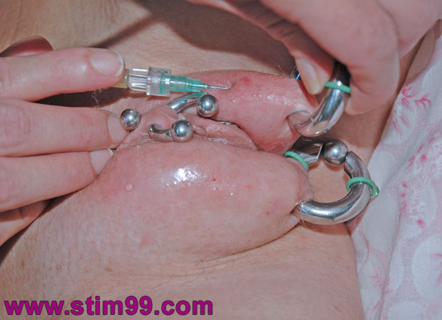 Injection saline with catheter in pussy lips